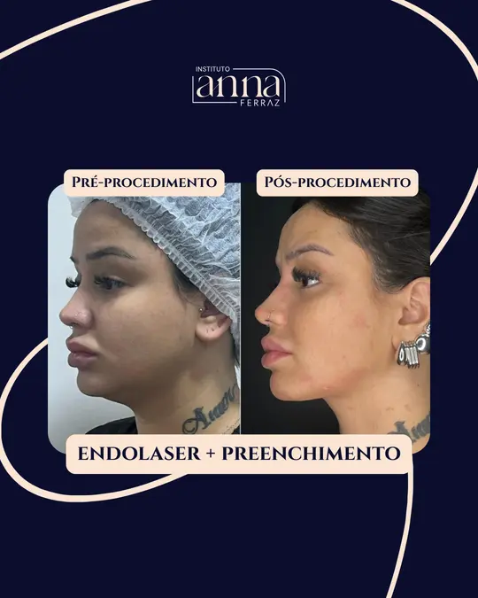 Antes e depois de harmonização orofacial — Endolaser + Preenchimento, resultado real no Espaço Anna Ferraz, São Paulo
