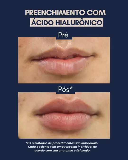 Antes e depois de harmonização orofacial — Preenchimento Labial, resultado real no Espaço Anna Ferraz, São Paulo