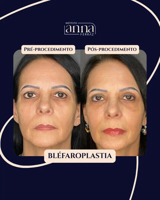 Antes e depois de harmonização orofacial — Blefaroplastia, resultado real no Espaço Anna Ferraz, São Paulo