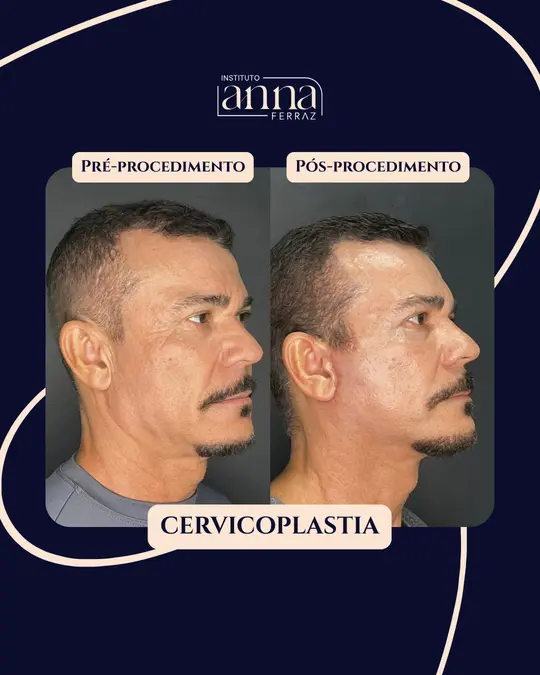 Antes e depois de harmonização orofacial — Cervicoplastia, resultado real no Espaço Anna Ferraz, São Paulo