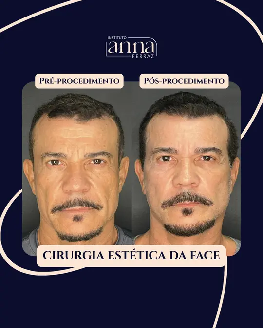Antes e depois de harmonização orofacial — Cirurgia Estética da Face, resultado real no Espaço Anna Ferraz, São Paulo