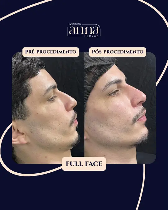Antes e depois de harmonização orofacial — Full Face, resultado real no Instituto Anna Ferraz, São Paulo
