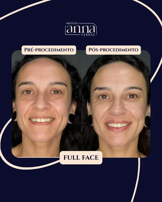 Antes e depois de harmonização orofacial — Full Face, resultado real no Espaço Anna Ferraz, São Paulo