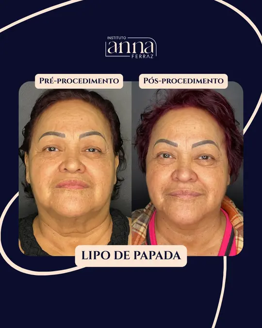 Antes e depois de harmonização orofacial — Lipo de Papada, resultado real no Espaço Anna Ferraz, São Paulo