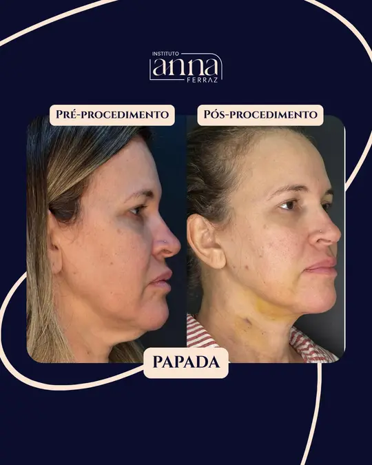 Antes e depois de harmonização orofacial — Papada, resultado real no Espaço Anna Ferraz, São Paulo