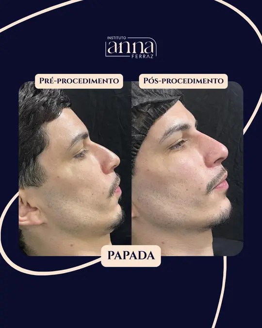 Antes e depois de harmonização orofacial — Papada, resultado real no Espaço Anna Ferraz, São Paulo